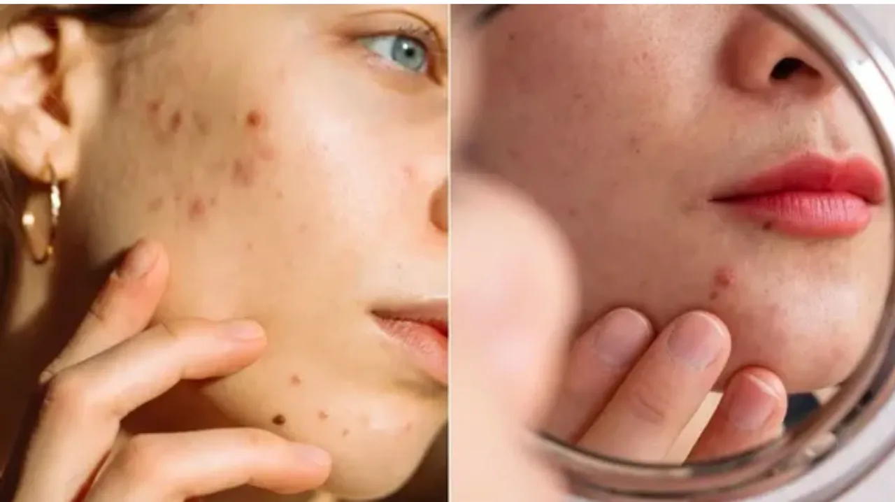 Fade Acne Marks with an Effective Cream for Clearer, Even Skin