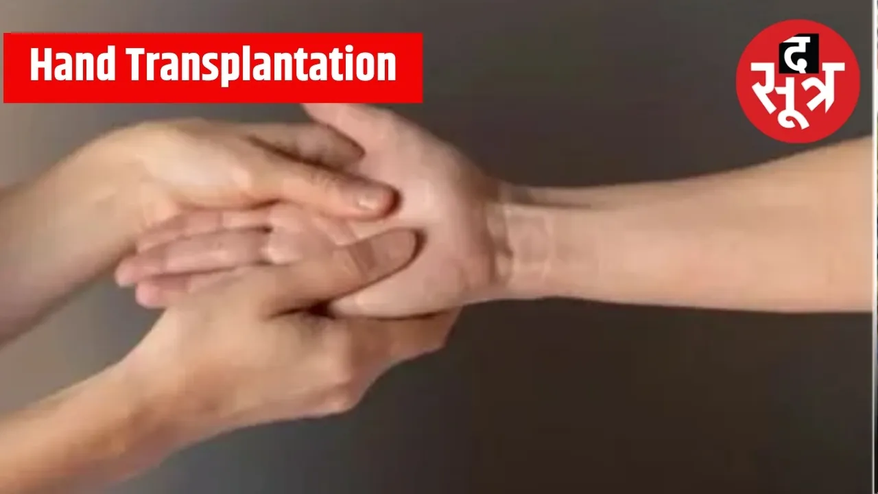 MP Hand Transplantation