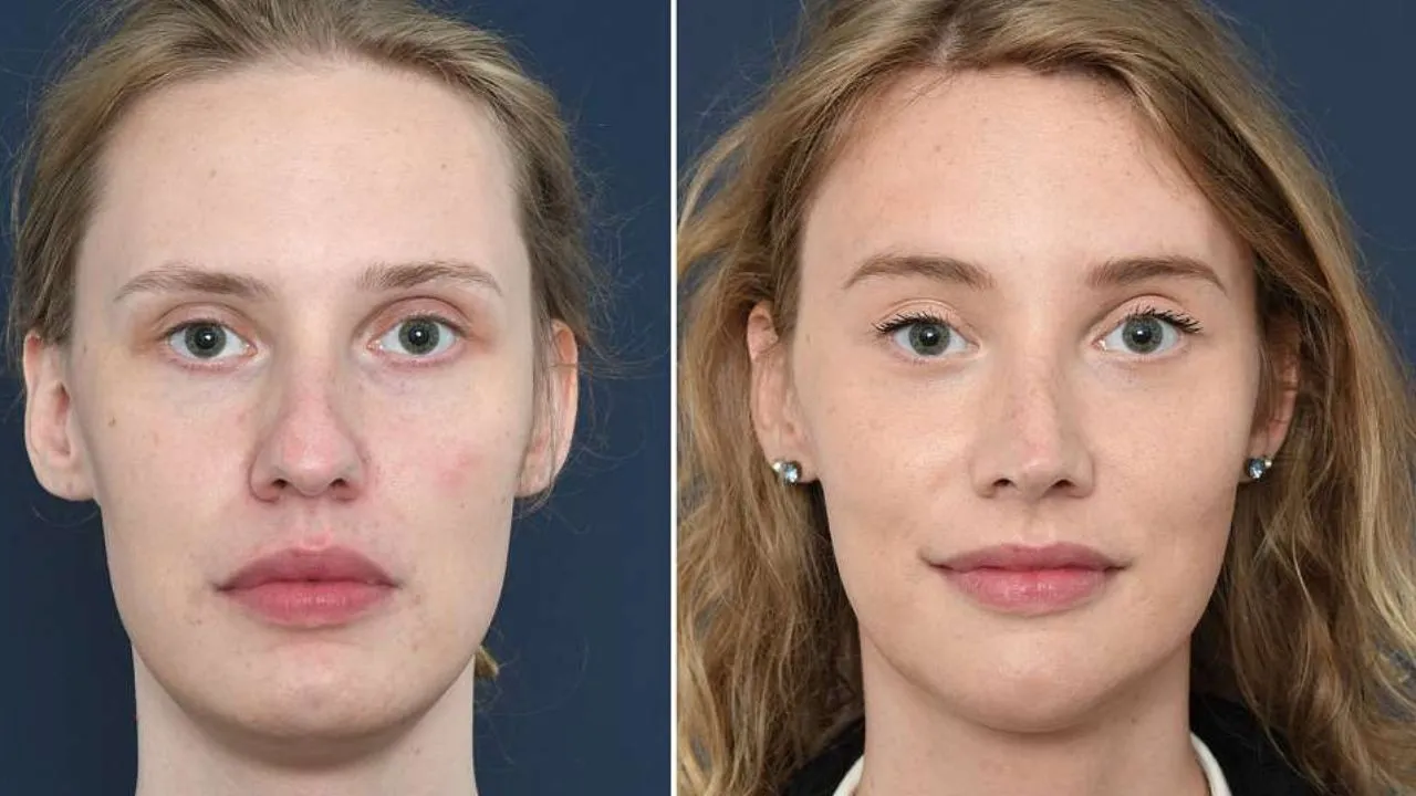 Facial Feminisation Surgery