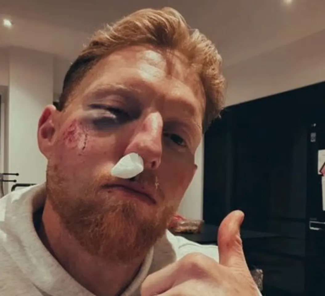 'Cricket balls do serious damage': Stokes vows to 'always wear helmet' after facial injury