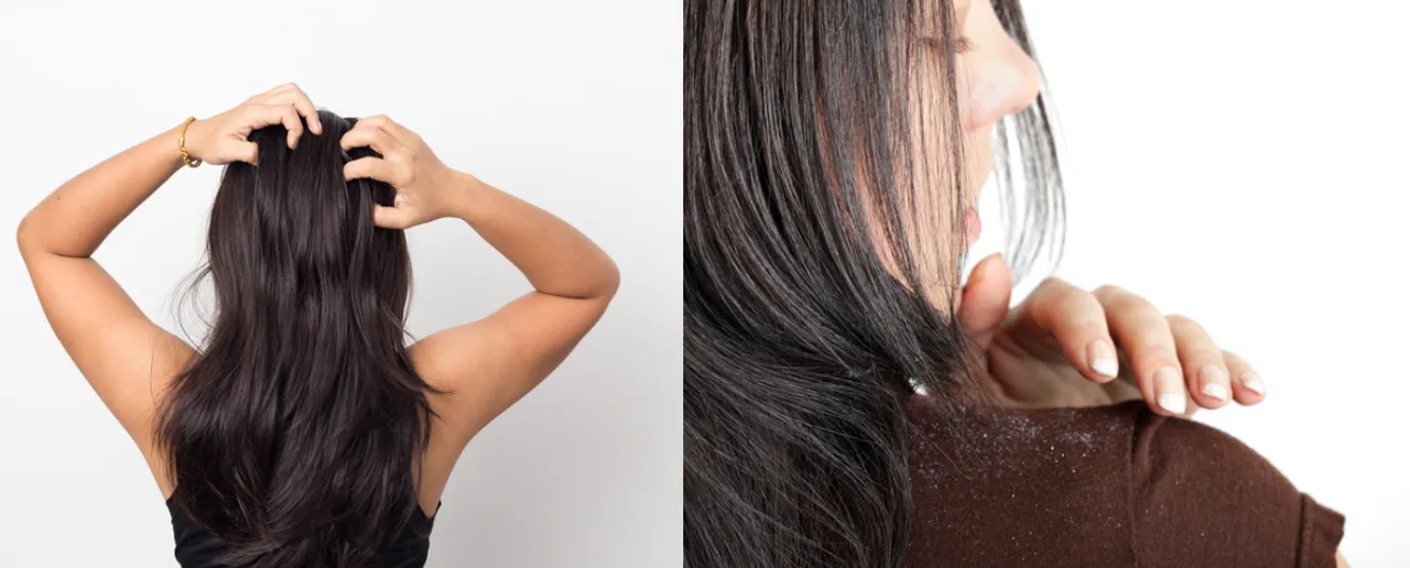 Dandruff