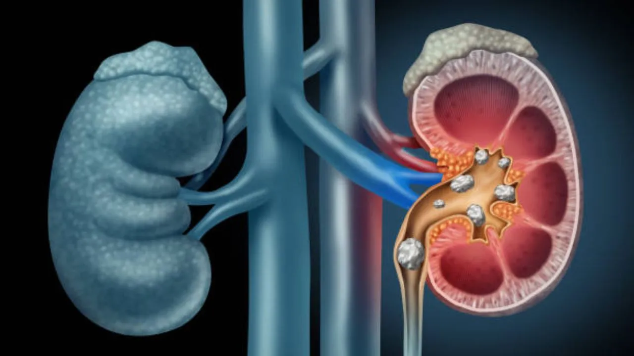 kidney stone