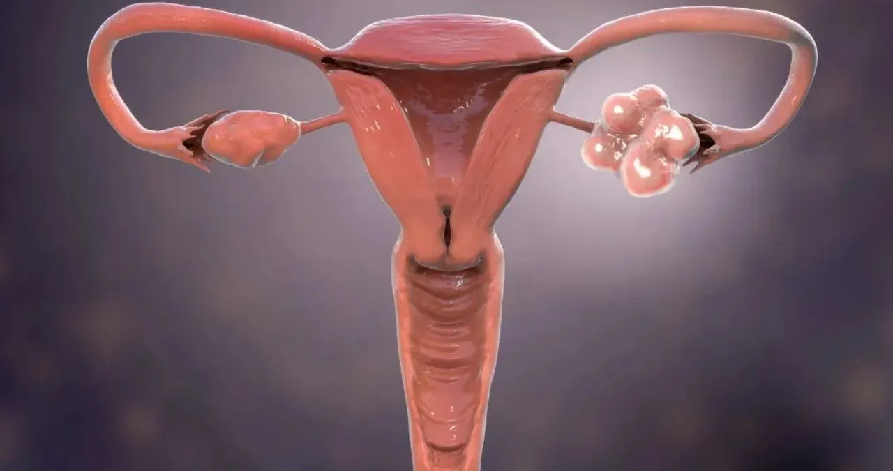 pcos naturl.jpg