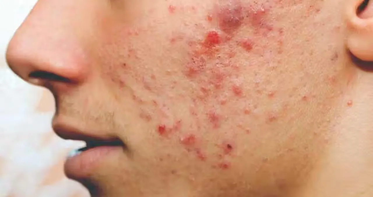 pimple remedy tips.jpg