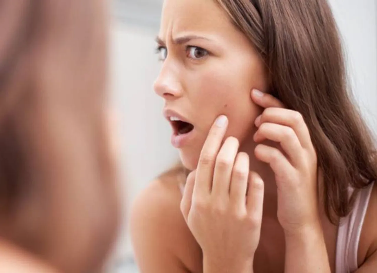 Pimple Remove Tips: முகப்பருக்களை விரைவில் நீக்க இதைவிட சிறந்த வழி இருக்க முடியாது!
