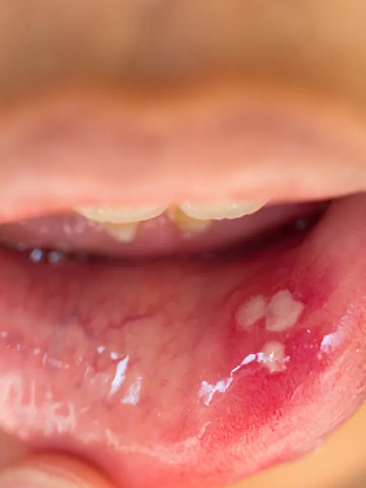 mouth ulcer - unsplash (1)