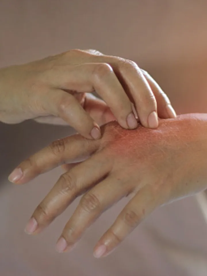 Skin allergy 2 - unsplash (1)