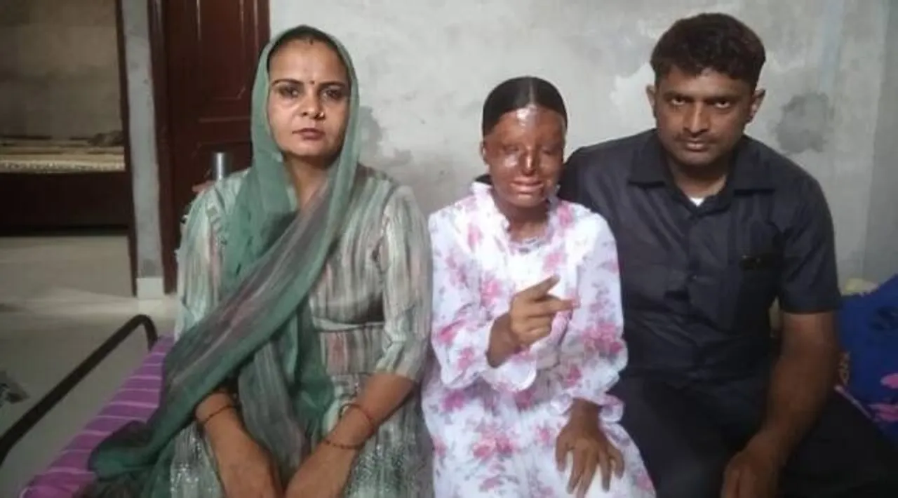 acid attack survivor