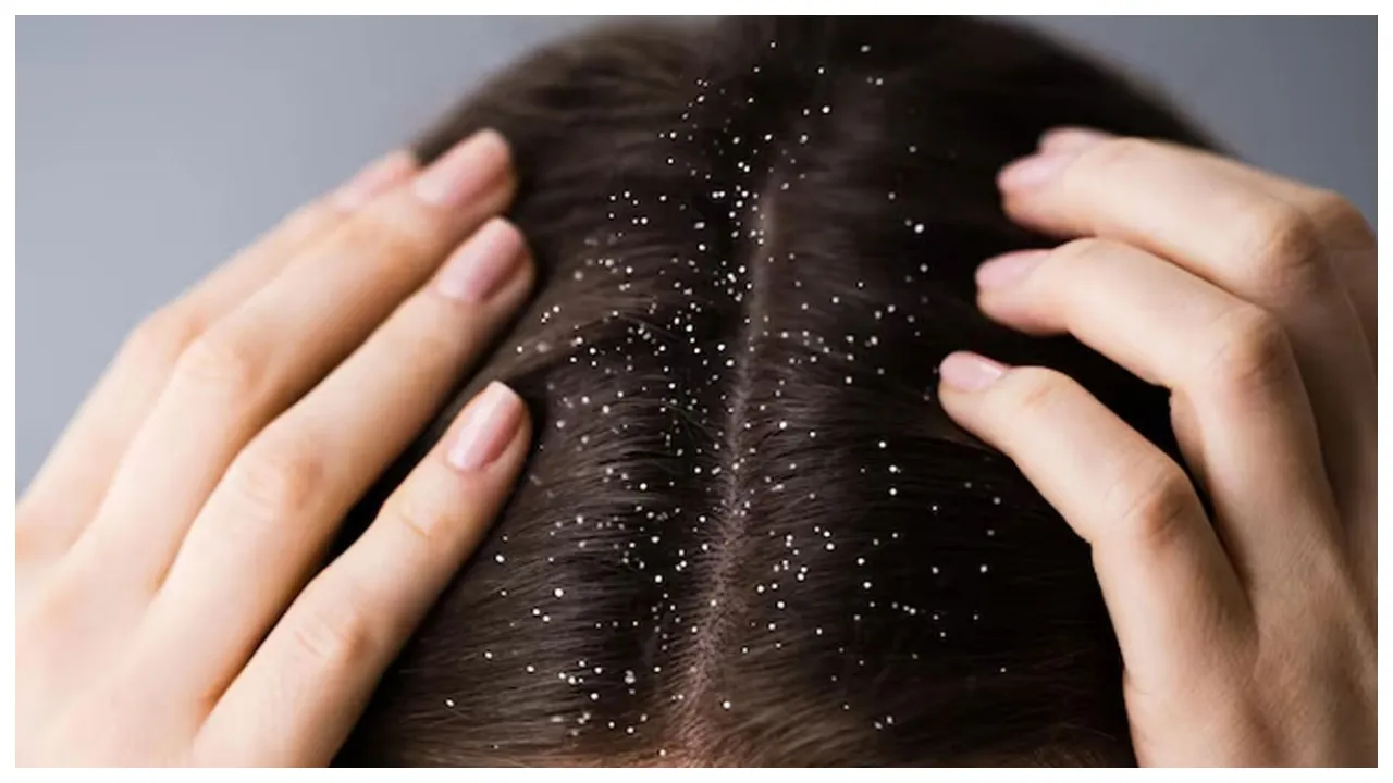 Dandruff Problem
