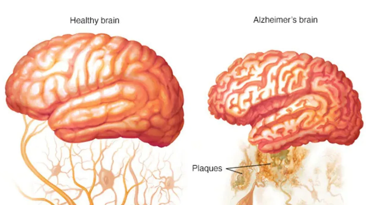 alzheimer's disease