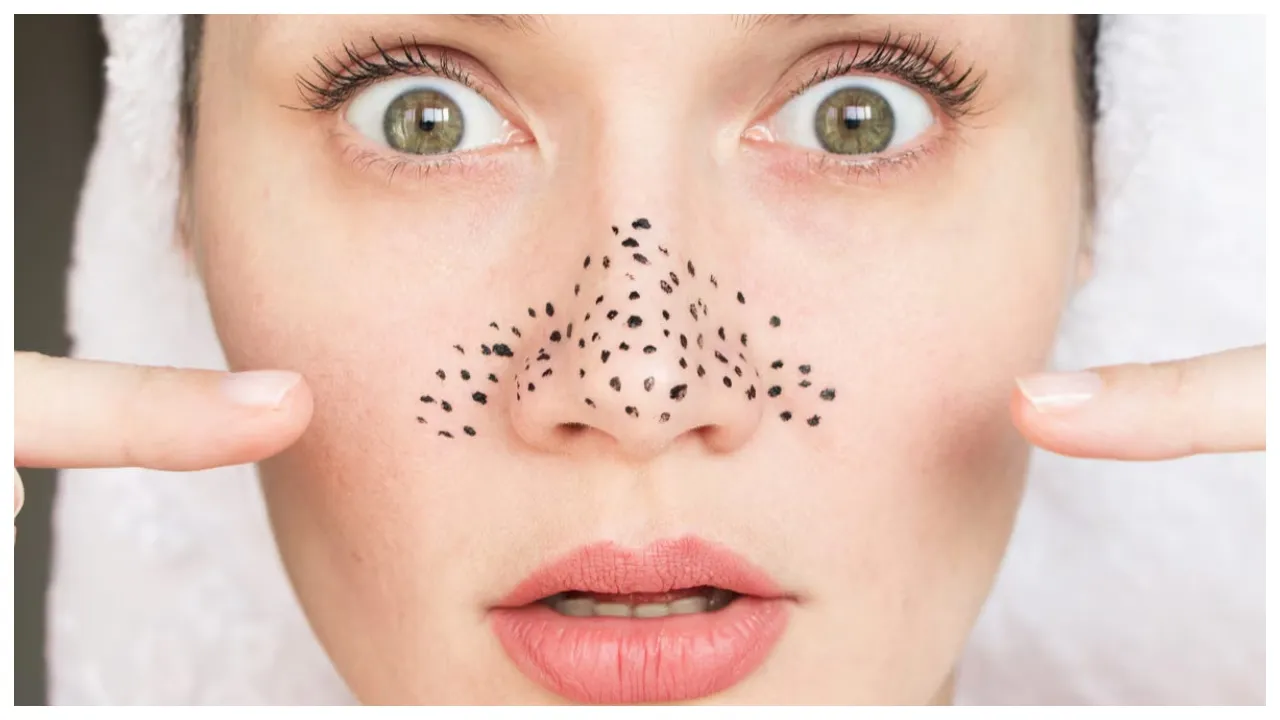 Blackheads