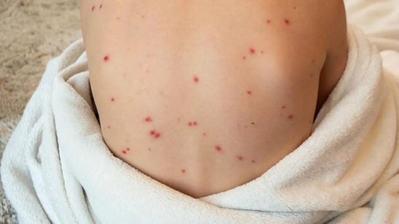 measles