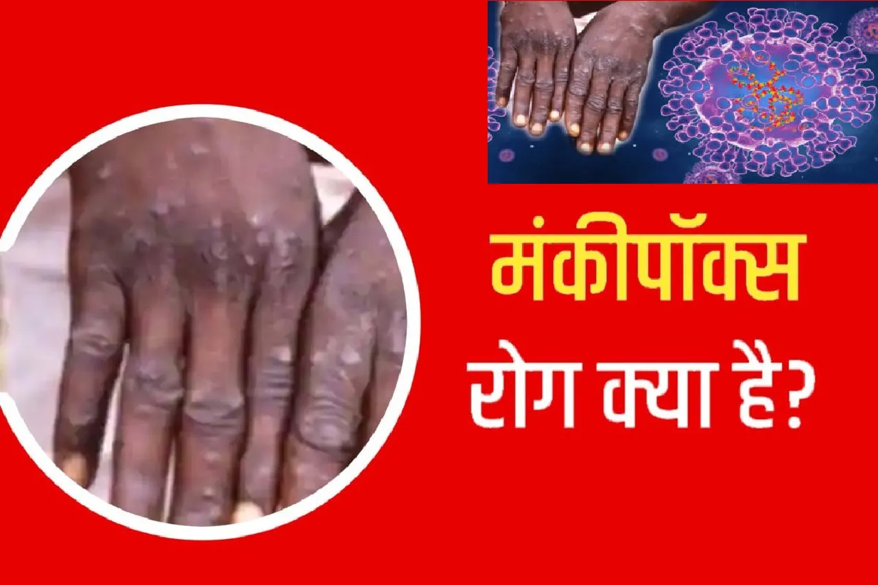 MONKEYPOX