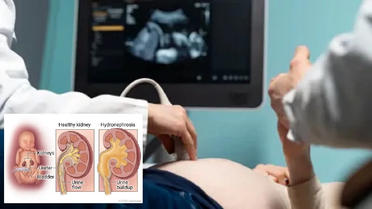 Hydronephrosis serious kidney disease unborn babies