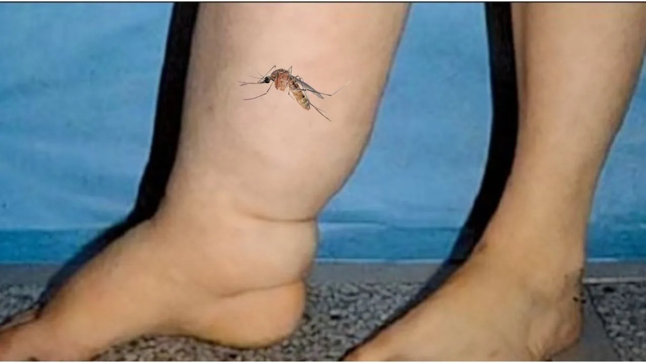 filariasis