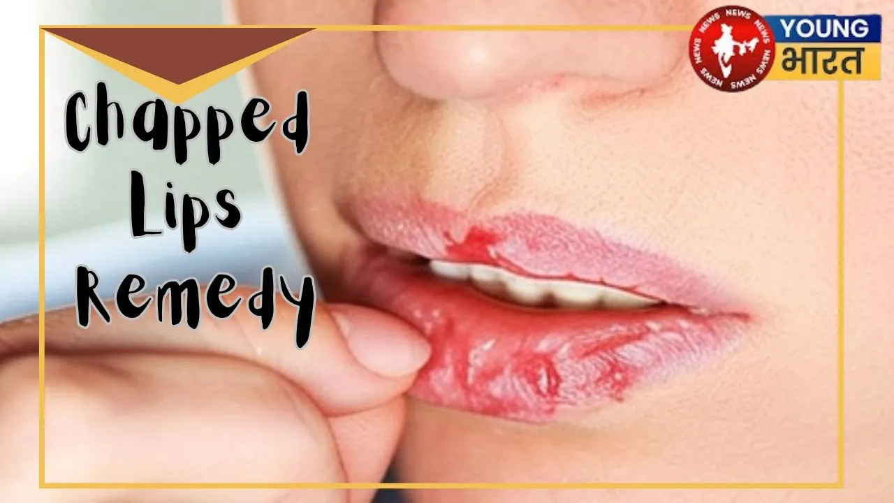 Chapped  Lips  Remedy
