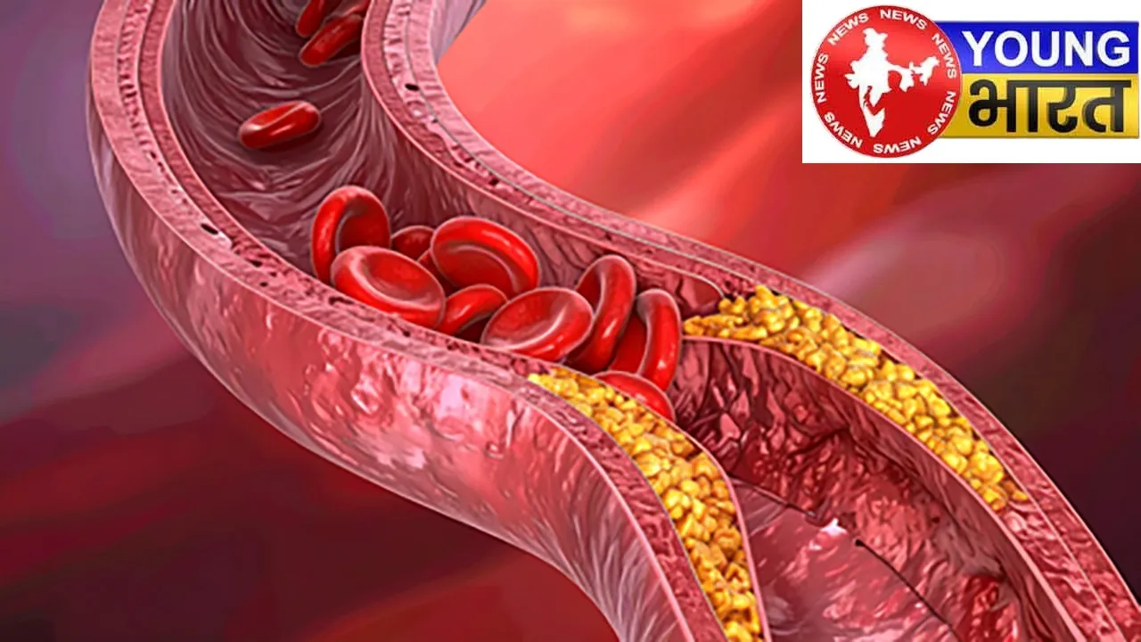 cholesterolblockages