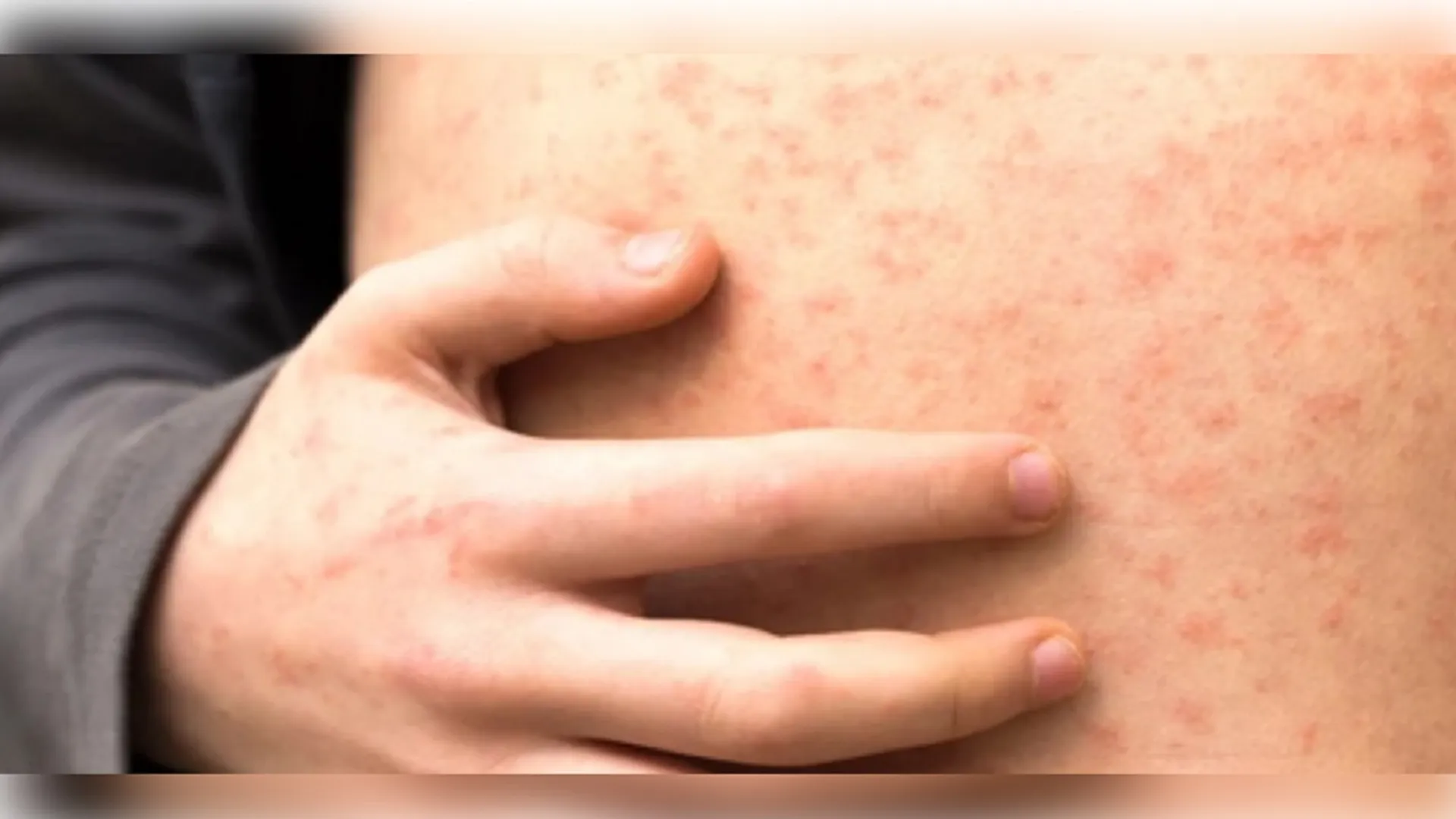 Measles