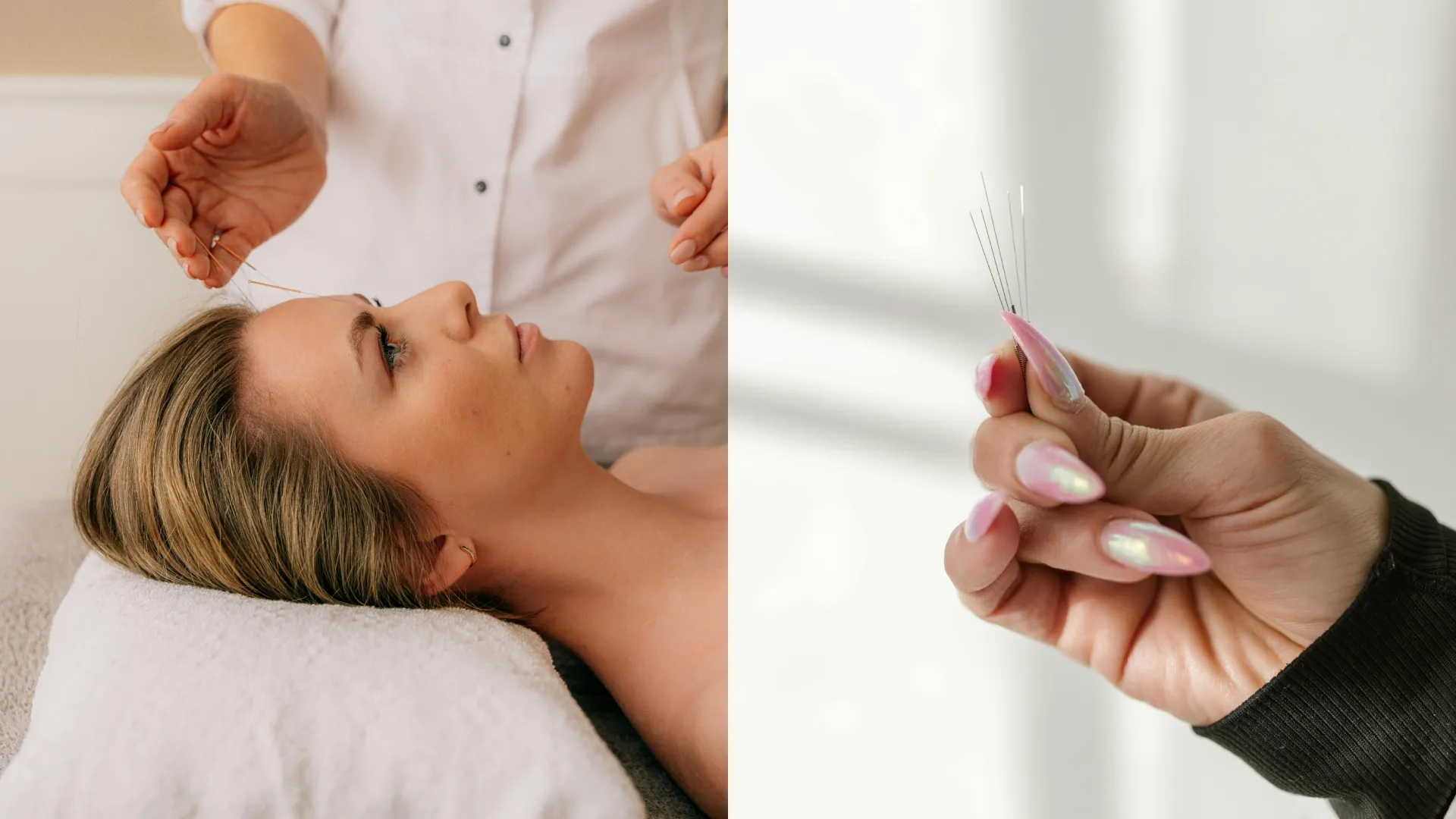 acupuncture