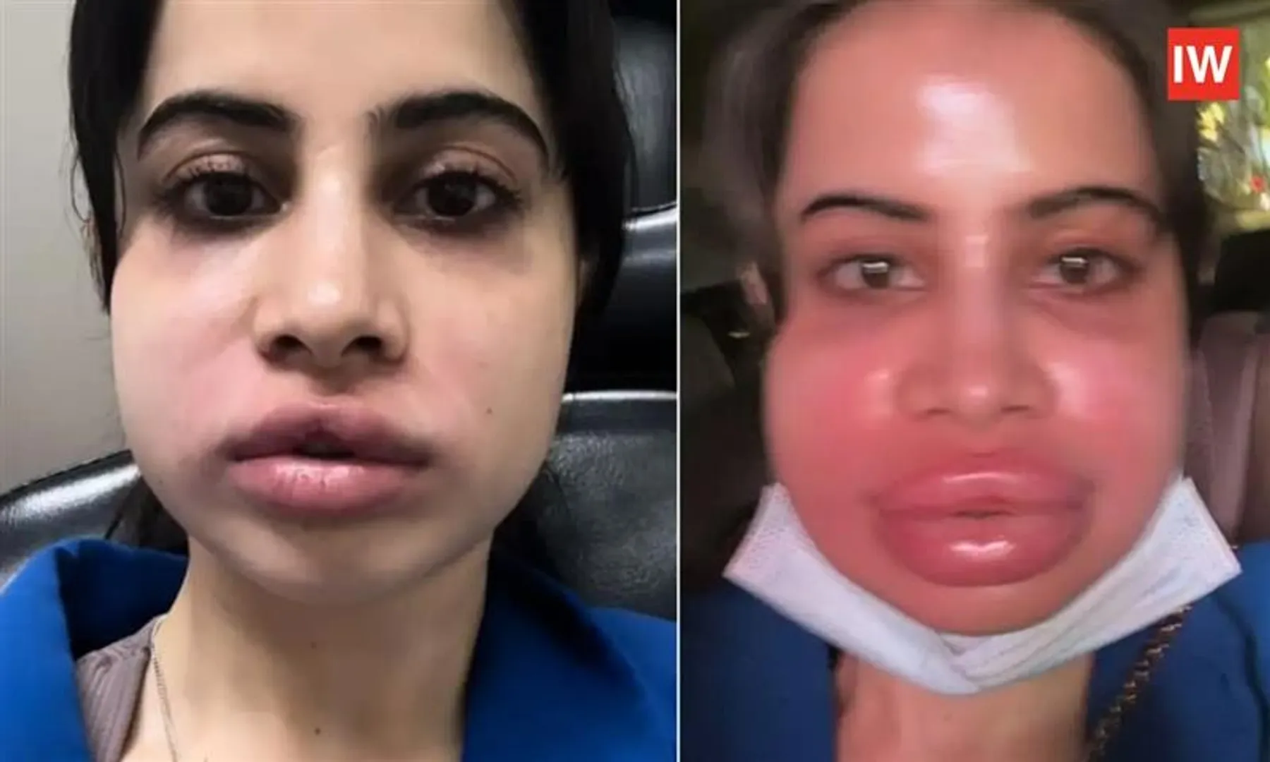 Urfi-Javed-Dissolves-Lip-Fillers,-Shares-Raw-Swollen-Face-Video-on-Instagram