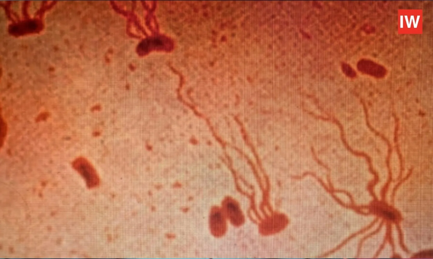 Drug-Resistant Typhoid