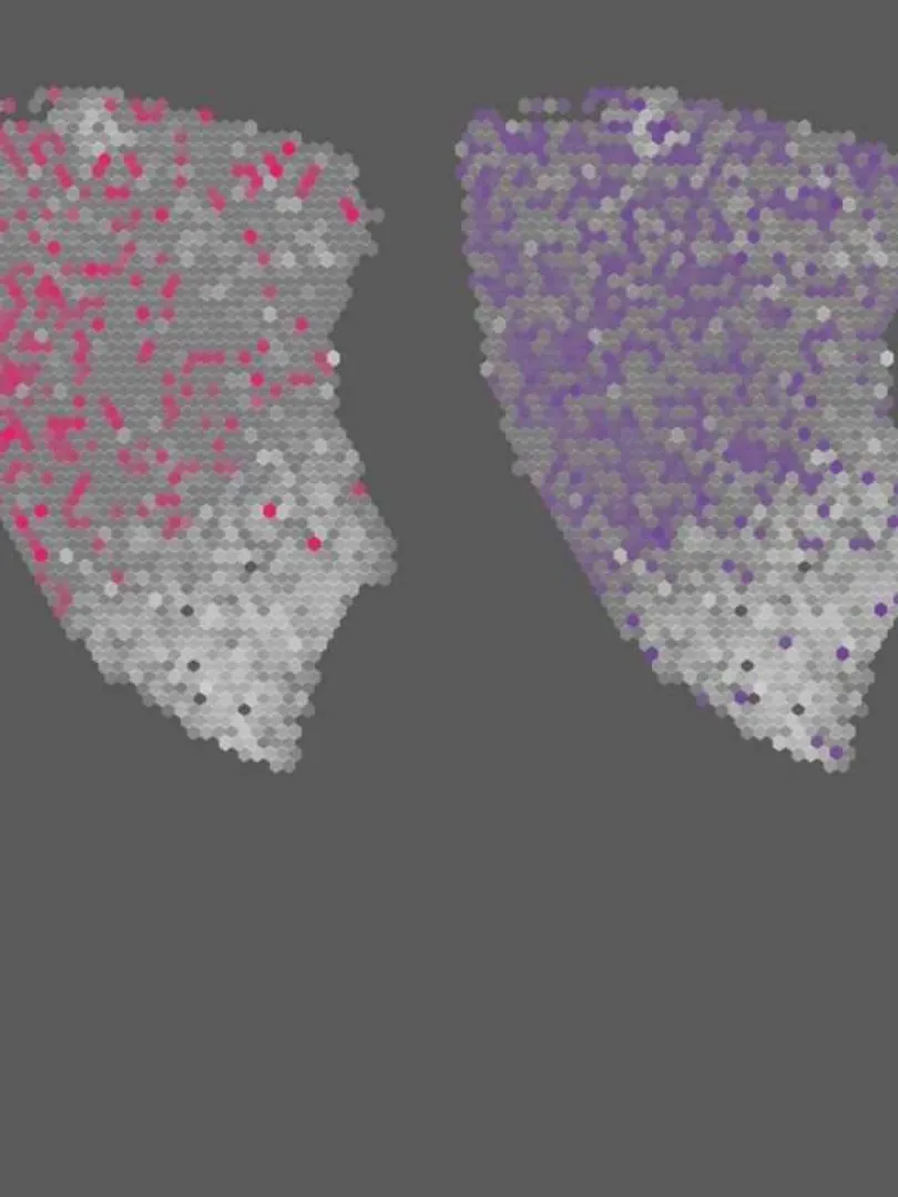 AI-Maps-Cellular-Patterns-in-Sarcoma-Prognosis
