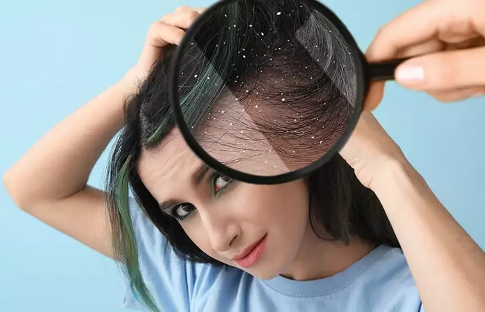 dandruff