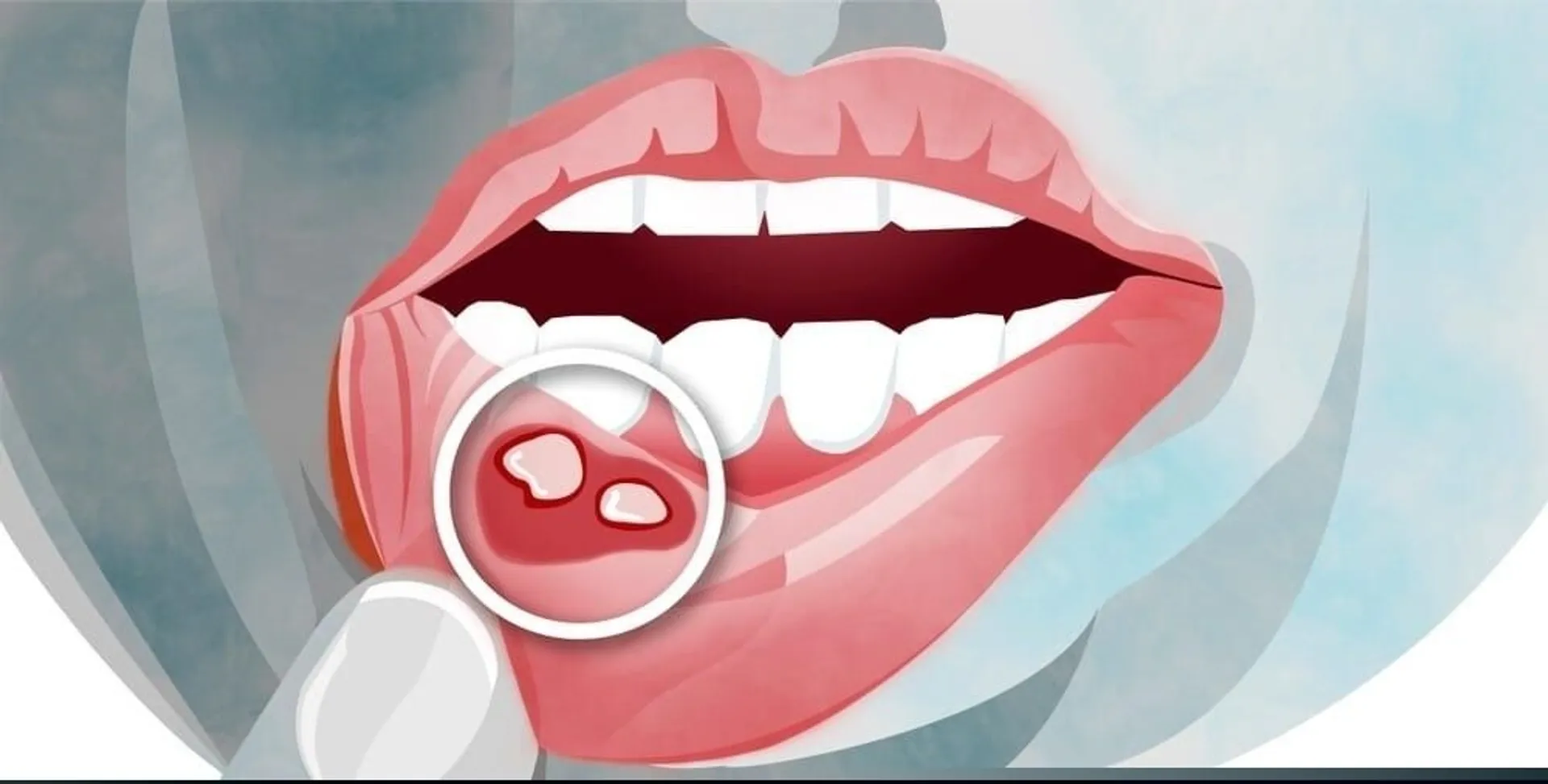 mouth-ulcers