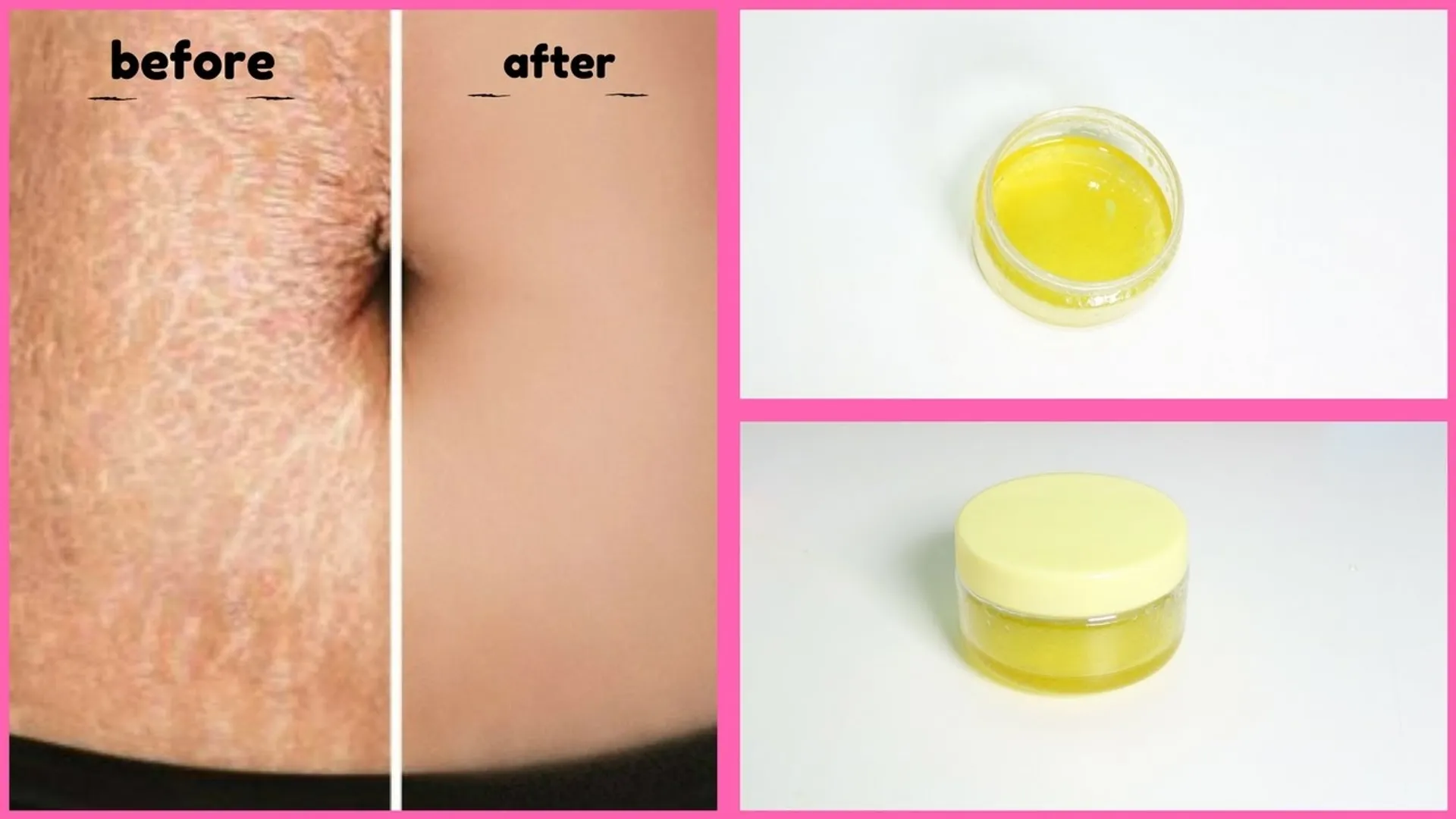 ପେଟରେ ଷ୍ଟ୍ରେଚମାର୍କ ବା ଦାଗ ପଡିଛି କି ? ଚିନ୍ତିତ ନହୋଇ ଏହାର ଉପଚାର ପାଇଁ ଜାଣନ୍ତୁ କିଛି ଆବଶ୍ୟକୀୟ ଟିପ୍ସ