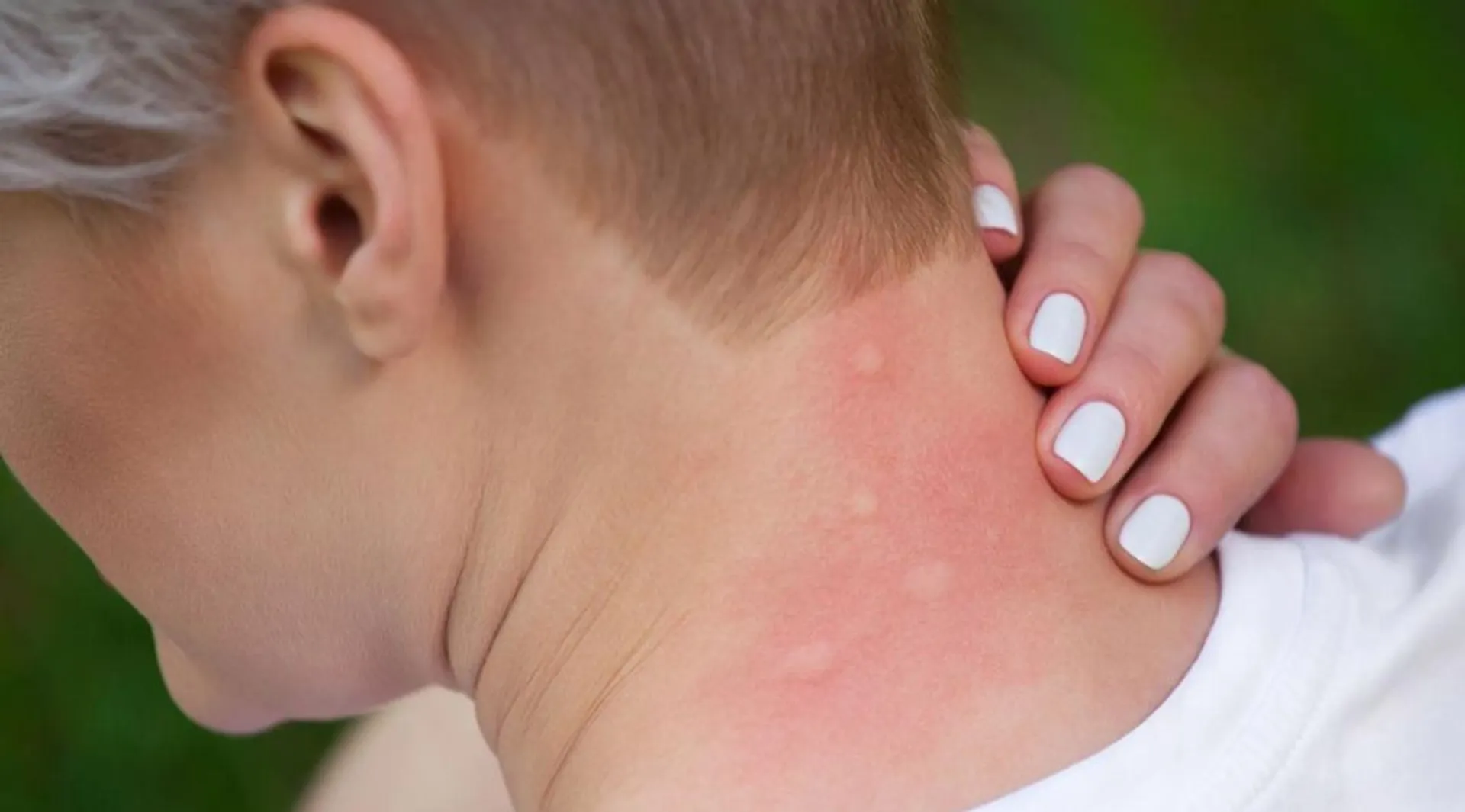 ଯେକୈାଣସି କୀଟ କାମୁଡିଲେ ବା ଦଂଶନ କଲେ ଆପଣାନ୍ତୁ ଏହି ଘରୋଇ ଉପାୟ। 