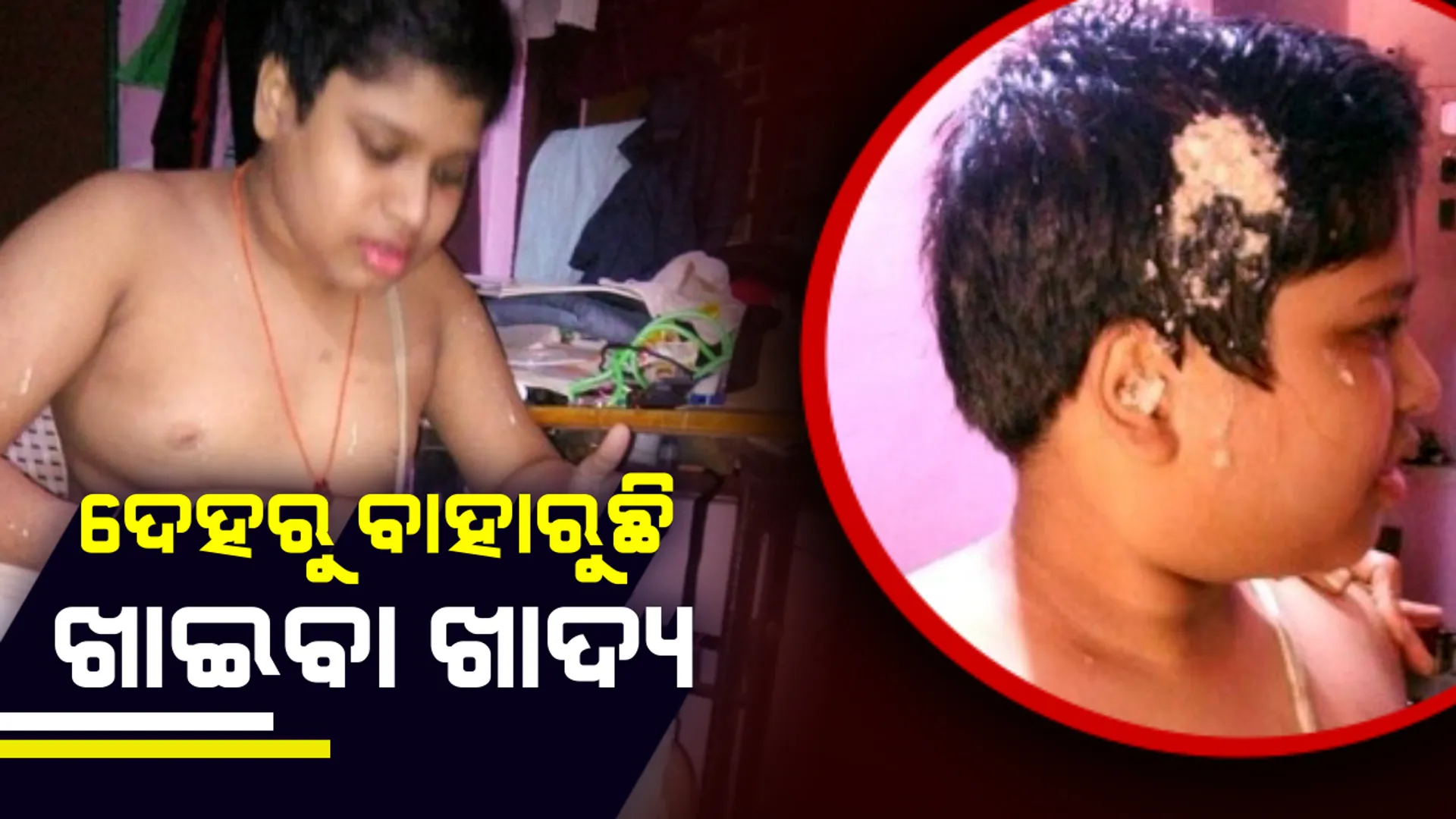 ଏଭଳି ଏକ ଅଦ୍ଭୁଦ ରୋଗ ଯେଉଁଠି ଶରୀରରୁ ବାହାରୁଛି ଖାଇବା ଖାଦ୍ୟ ! ଡାକ୍ତର ଚିହ୍ନିପାରୁନାହାନ୍ତିି ରୋଗ ।