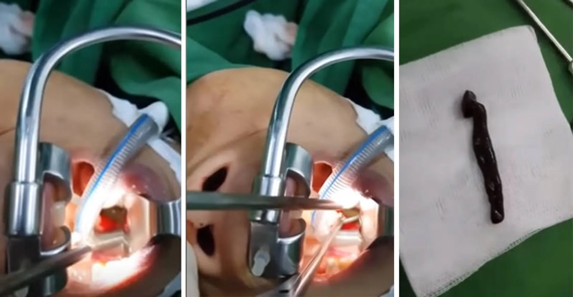 ବର୍ଷାପାଣିରେ ଭିଜିବାର ପରିଣାମ ! ମହିଳାଙ୍କ ପାଟିରୁ ବାହାରିଲା ଏଭଳି କିଛି ଡାକ୍ତର ବି ହୋଇଗଲେ ଆଶ୍ଚର୍ଯ୍ୟ ।