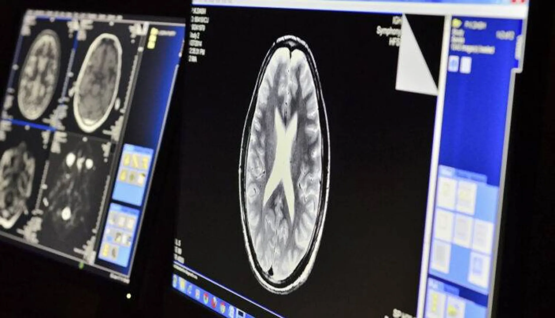 ଓଡ଼ିଶାରୁ ବ୍ରେନ ମ୍ୟାଲେରିଆ ପାଇଁ ବାହାରିଲା ଔଷଧ, ଜୀବଜନ୍ତୁଙ୍କ ଉପରେ ପରୀକ୍ଷଣ ସଫଳ । ଖୁବଶୀଘ୍ର ହେବ ମାନବ ପରୀକ୍ଷଣ ।