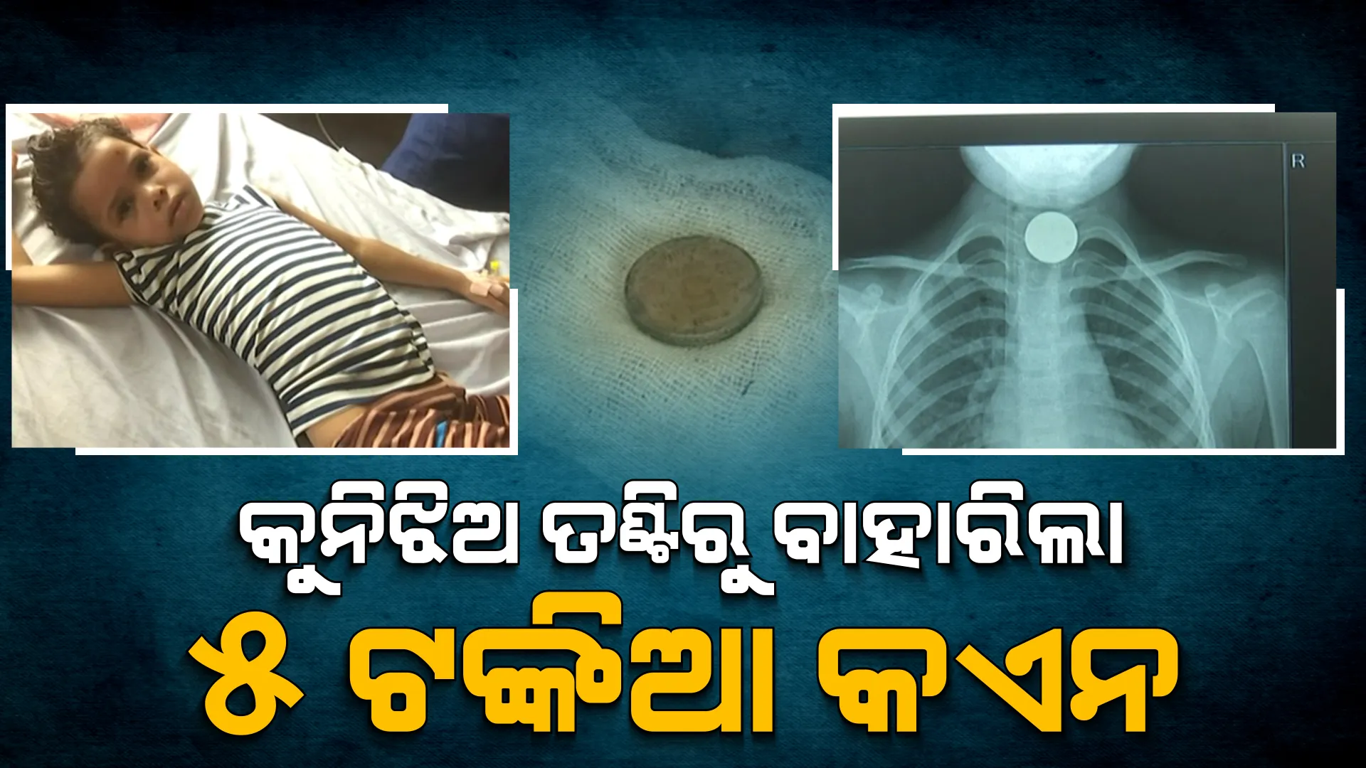 ବାଲେଶ୍ୱରର କୁନି ଝିଅ ଛାୟା ତଣ୍ଟିରୁ ବାହାରିଲା ୫ ଟଙ୍କିଆ କଏନ । କଟକ ବଡ ମେଡିକାଲରେ ବାହାର କଲେ ଡାକ୍ତର ।