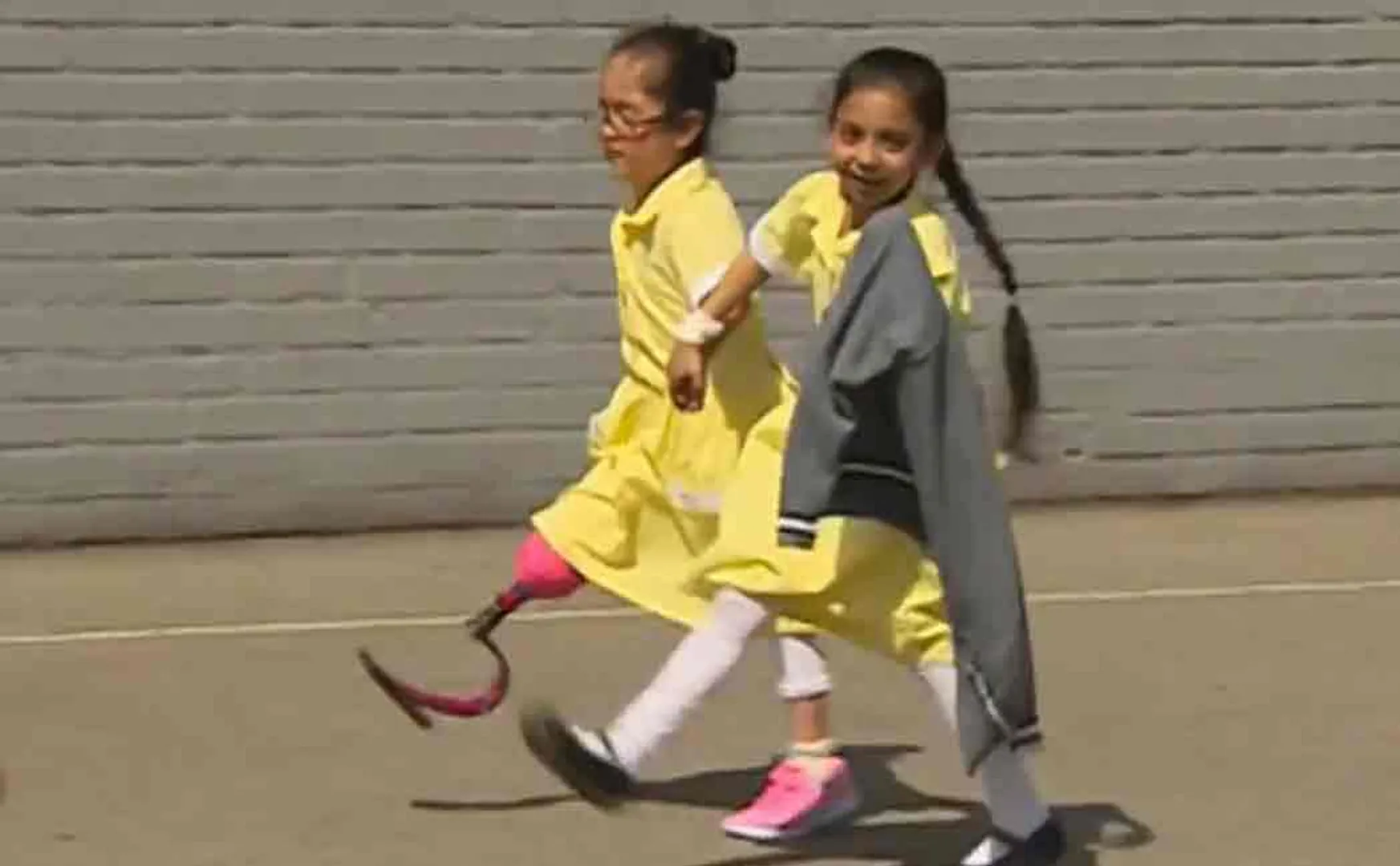 school girl enjoyed with friends after getting artificial leg