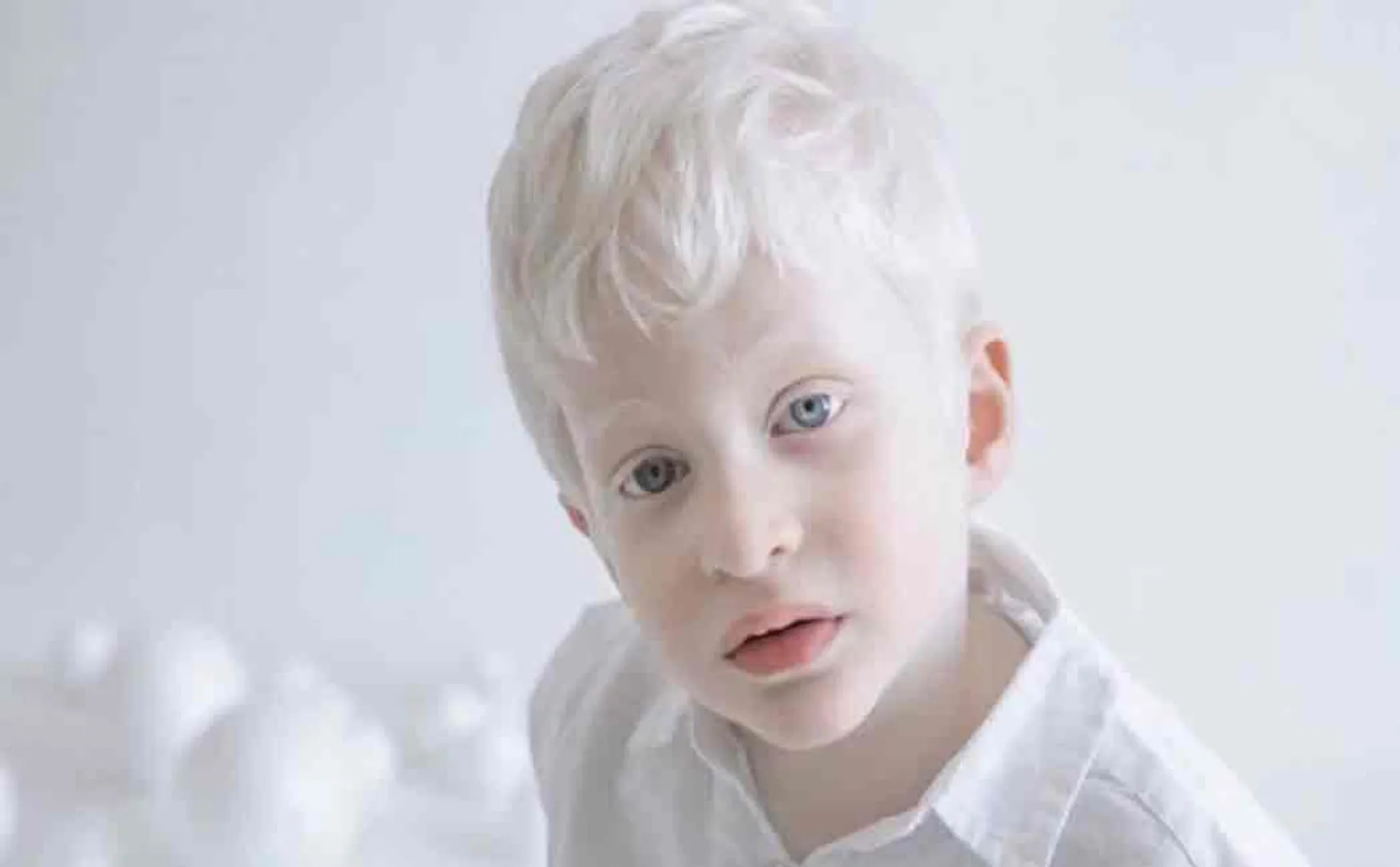tanzania albinism patient