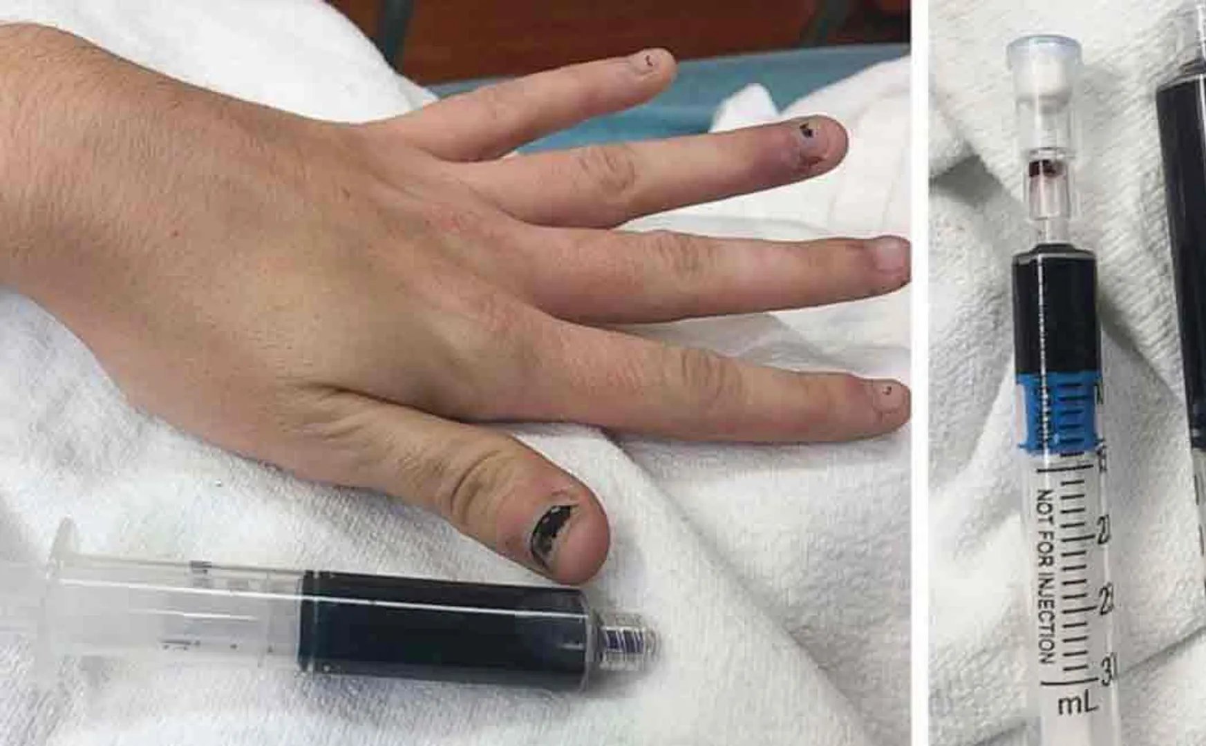 Common pain medication literally turns woman's blood blue