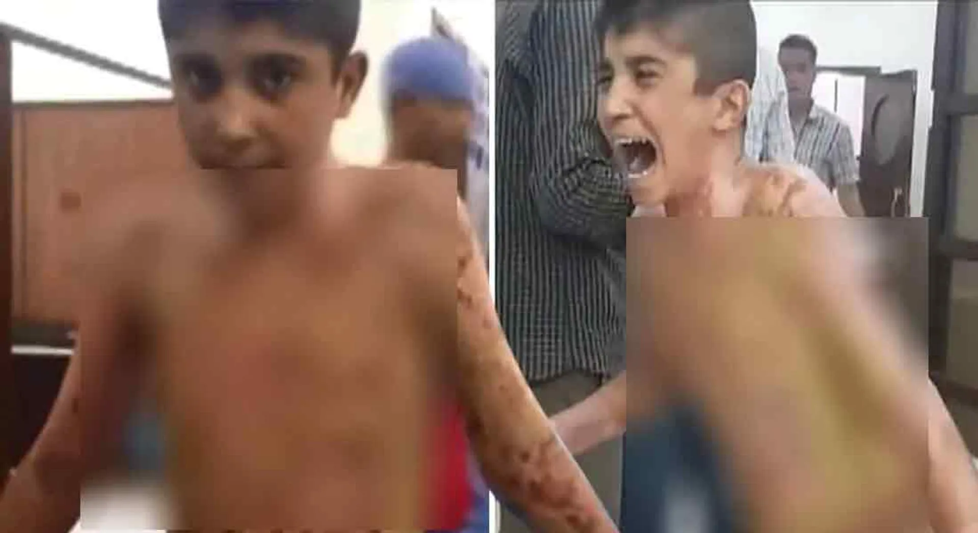 Syrian boy burnt to death with chemical weapon?