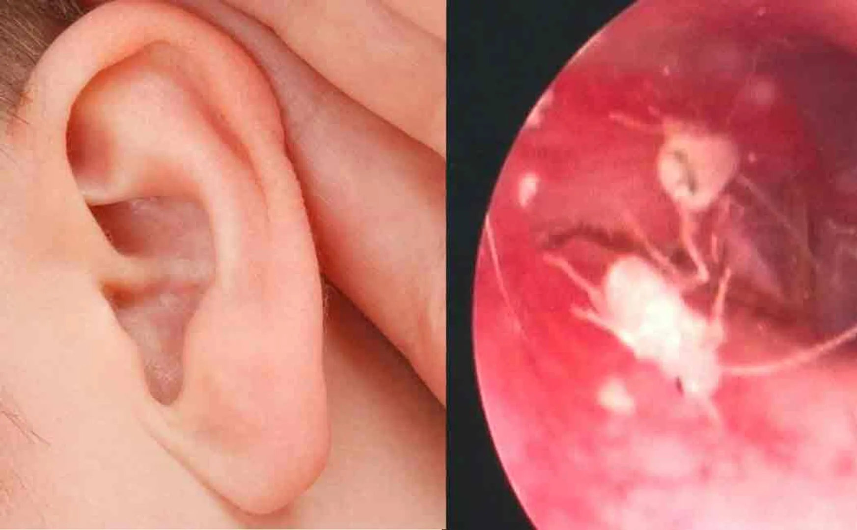 family of cockroaches found in a chinese mans ear