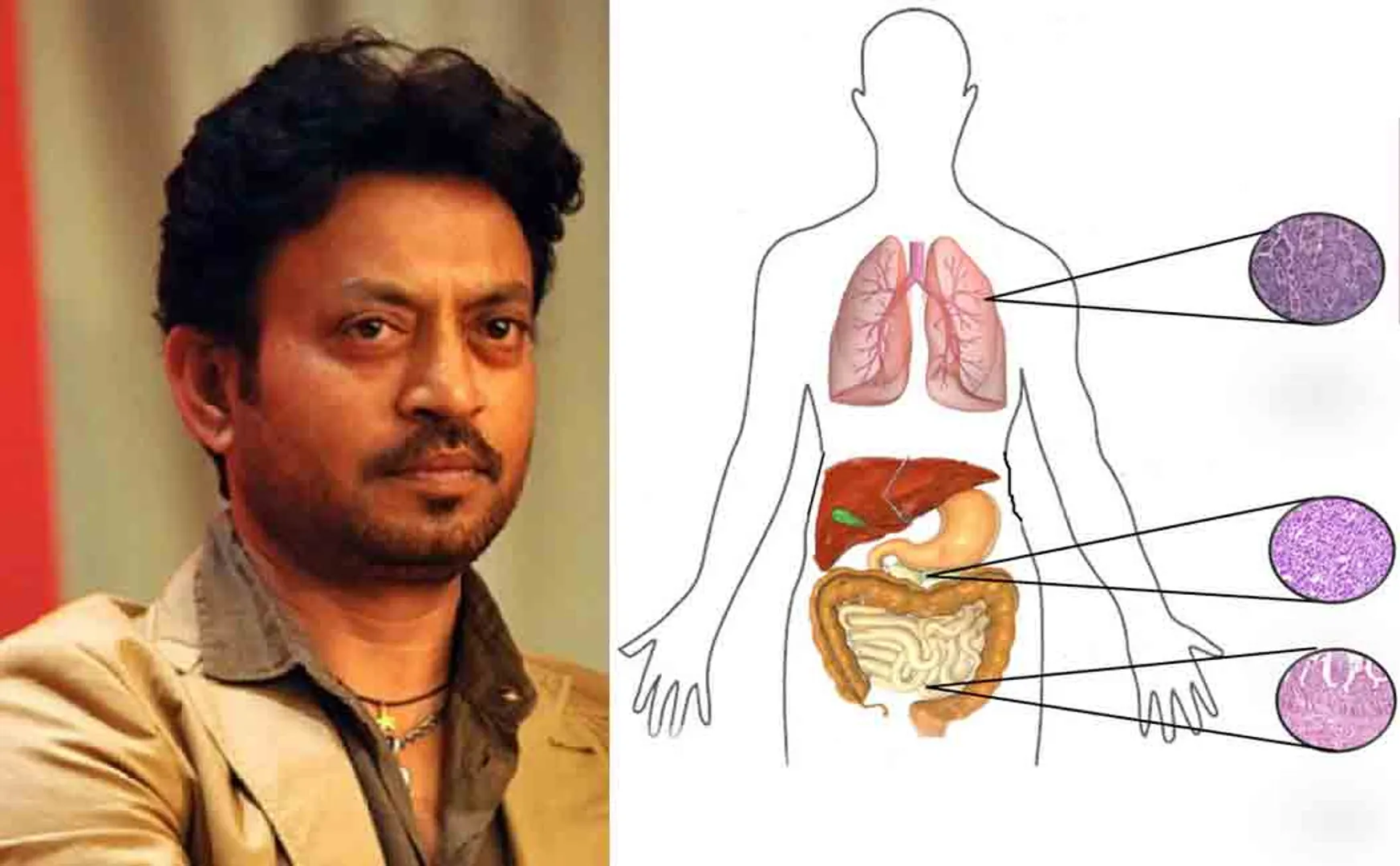 disease behind irrfan khan eave