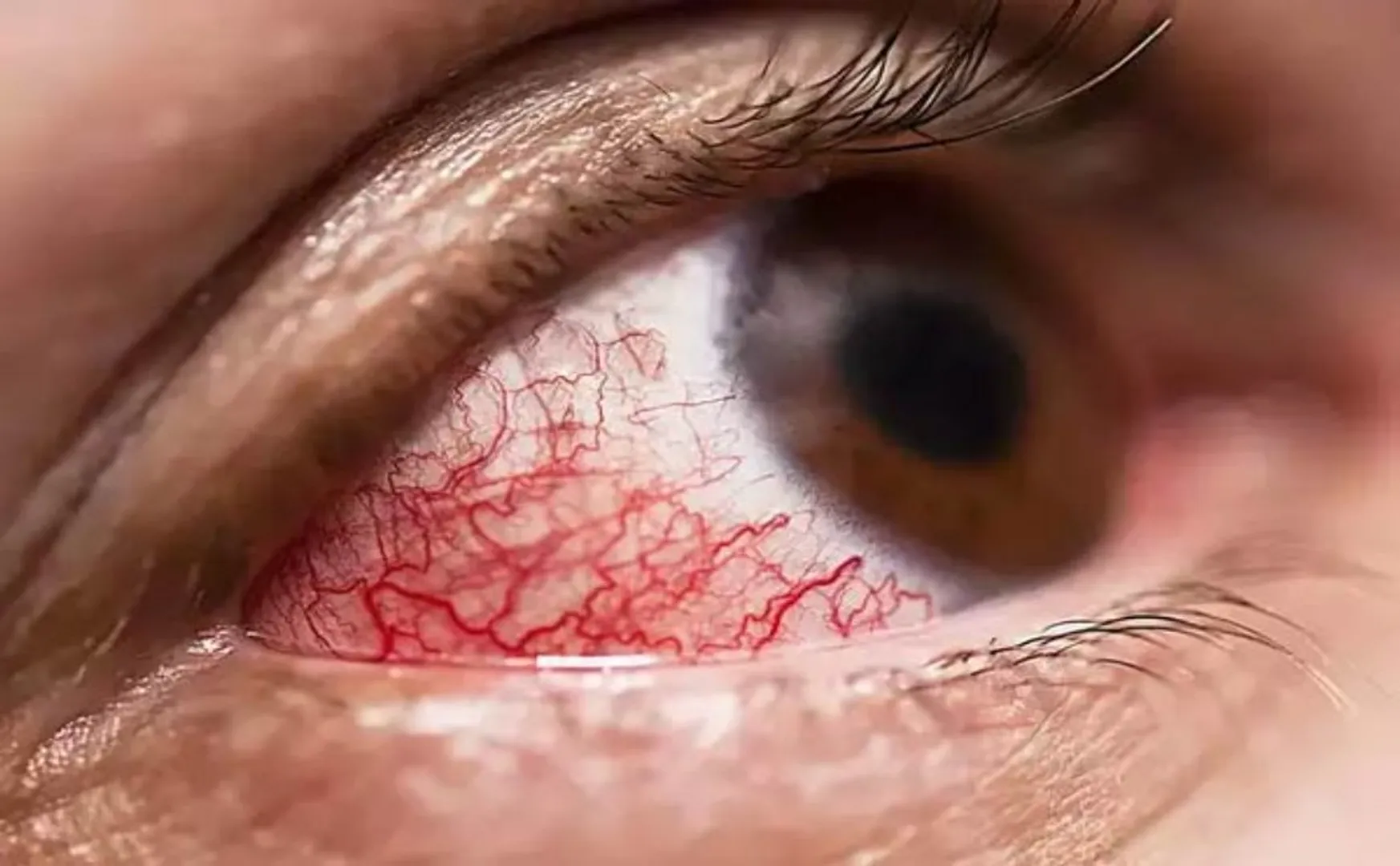 What are the symptoms of mycomycosis?