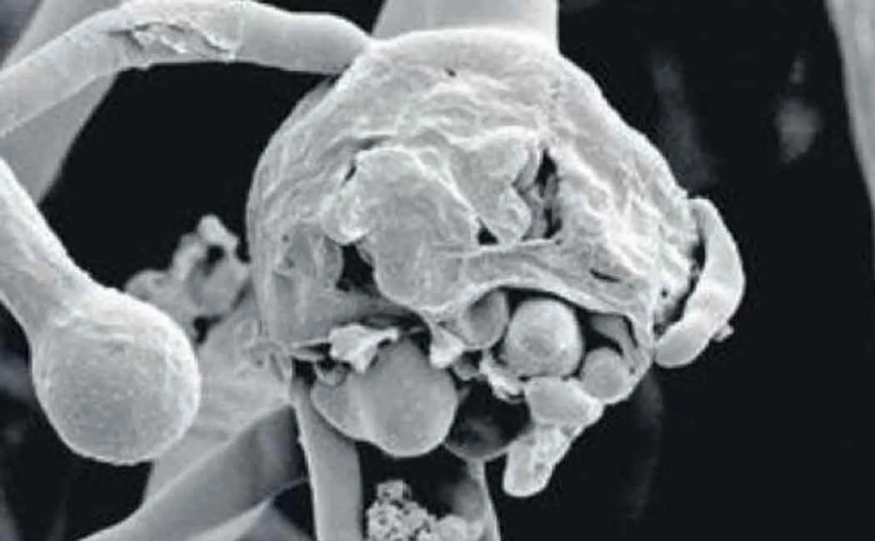 Medicine shortage for fungal diseases - relatives of patients suffering ..!