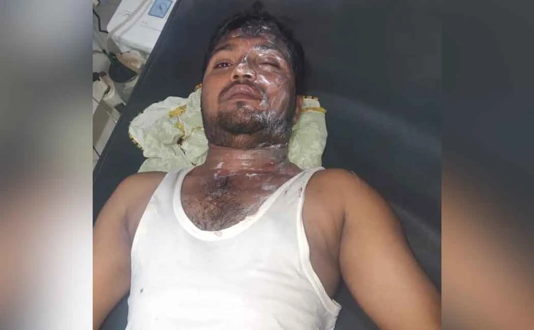 Acid attack on youth face