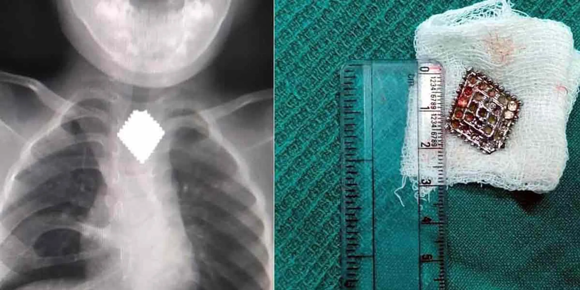 Removal of dollars stuck in the throat of a 4-year-old child ... Challenging achievement of the government hospital!