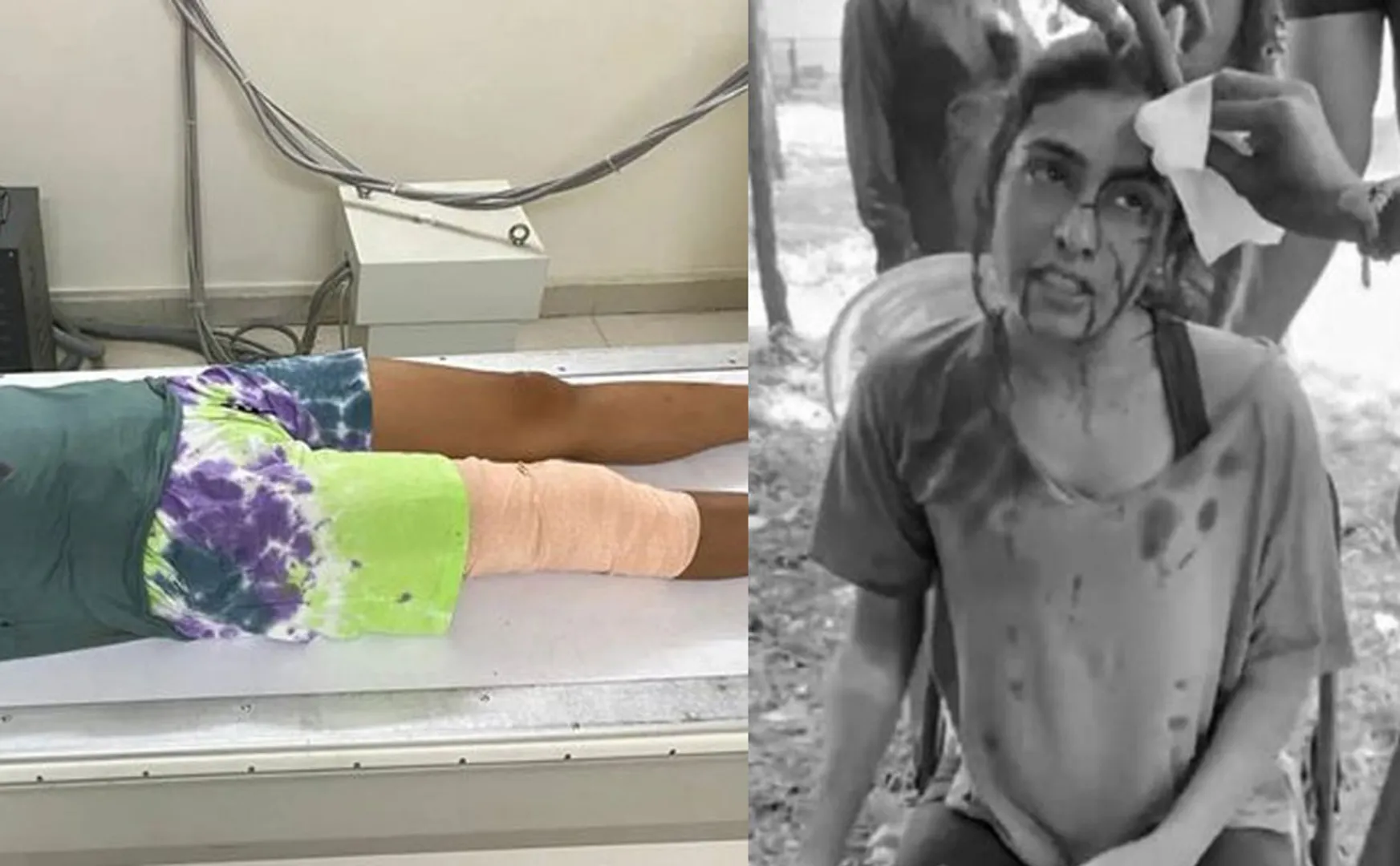  Actress Samyukta Hegde was seriously injured shooting spot 