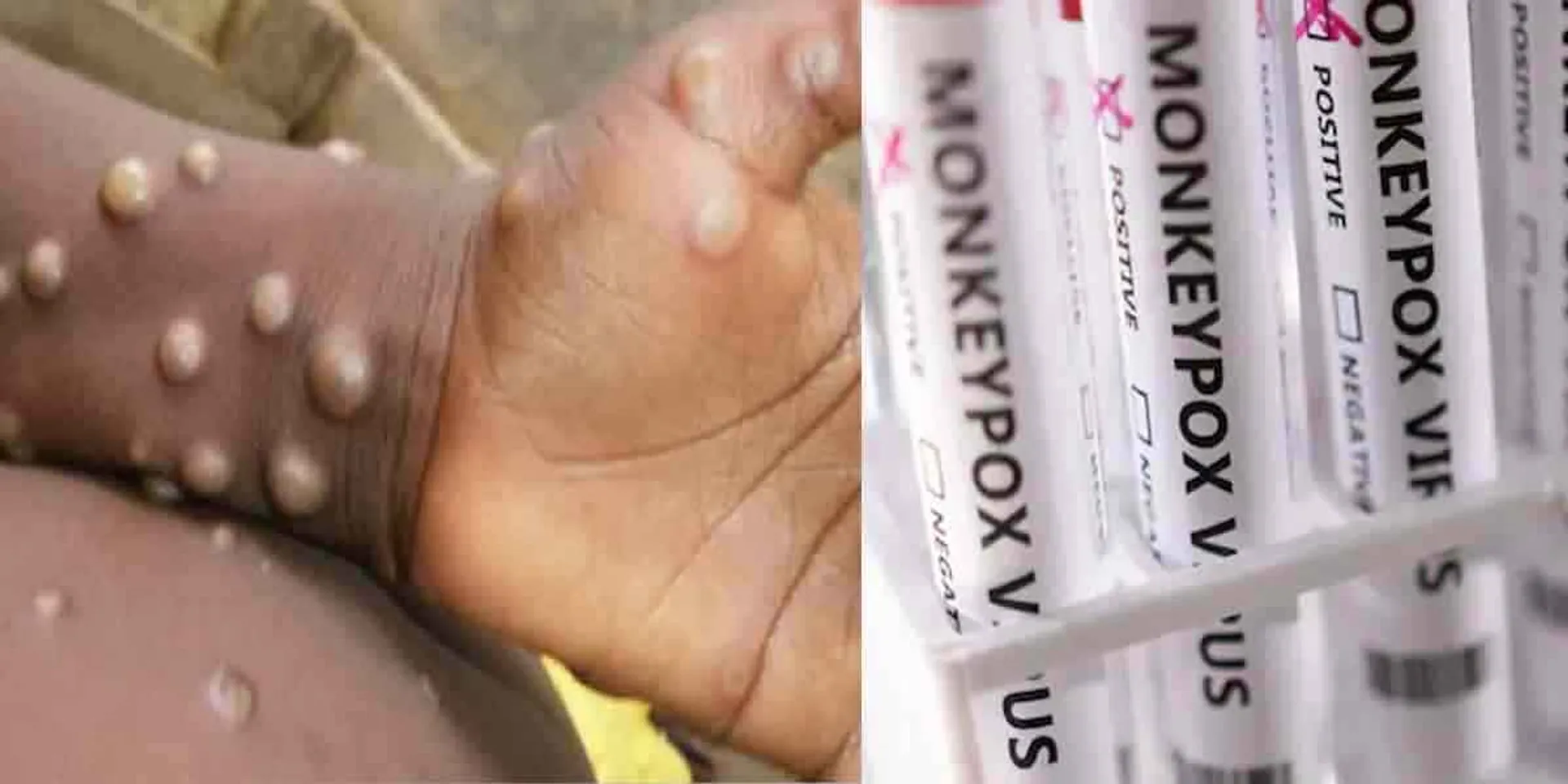 The World Health Organization is considering changing the name of monkey pox