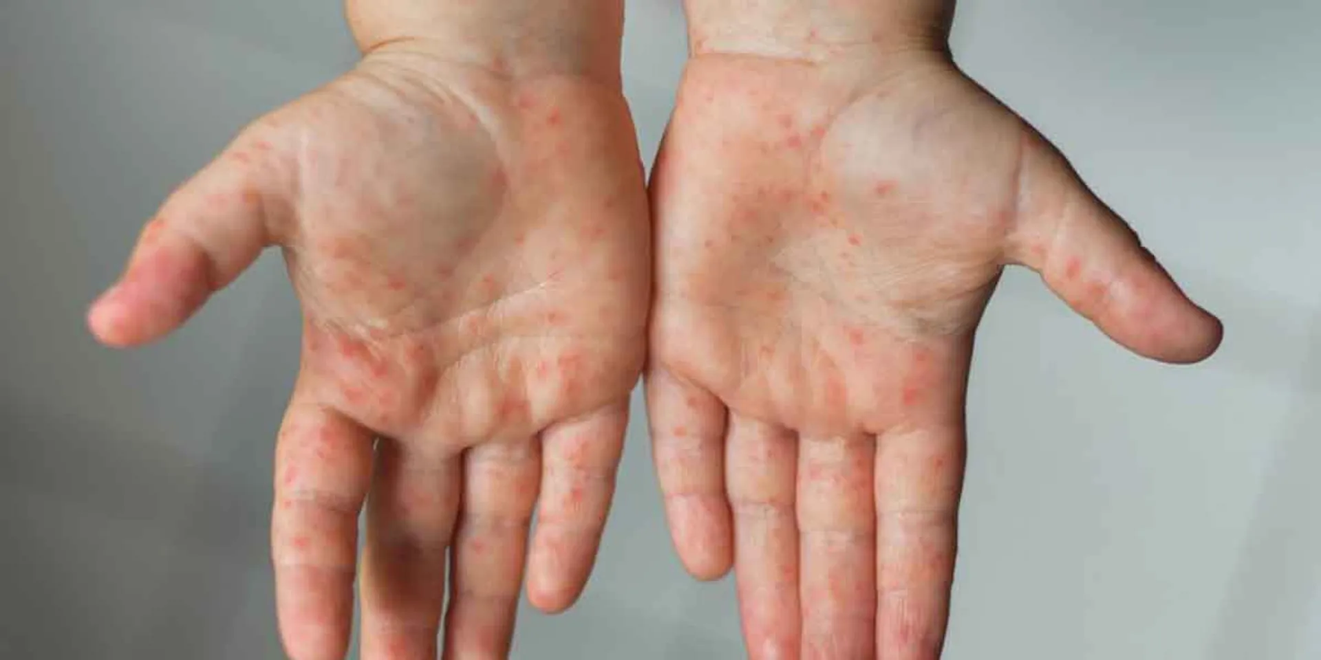  Tomato fever in children.. Lancet to warn