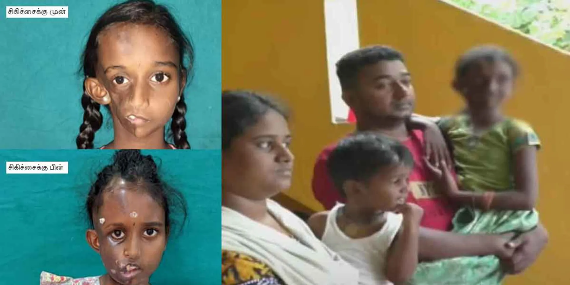  Baby Tanya's photo after treatment released!