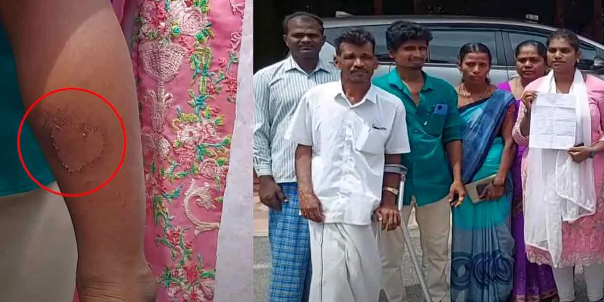 The boy's feet are hot... Parents accuse the Anganwadi staff