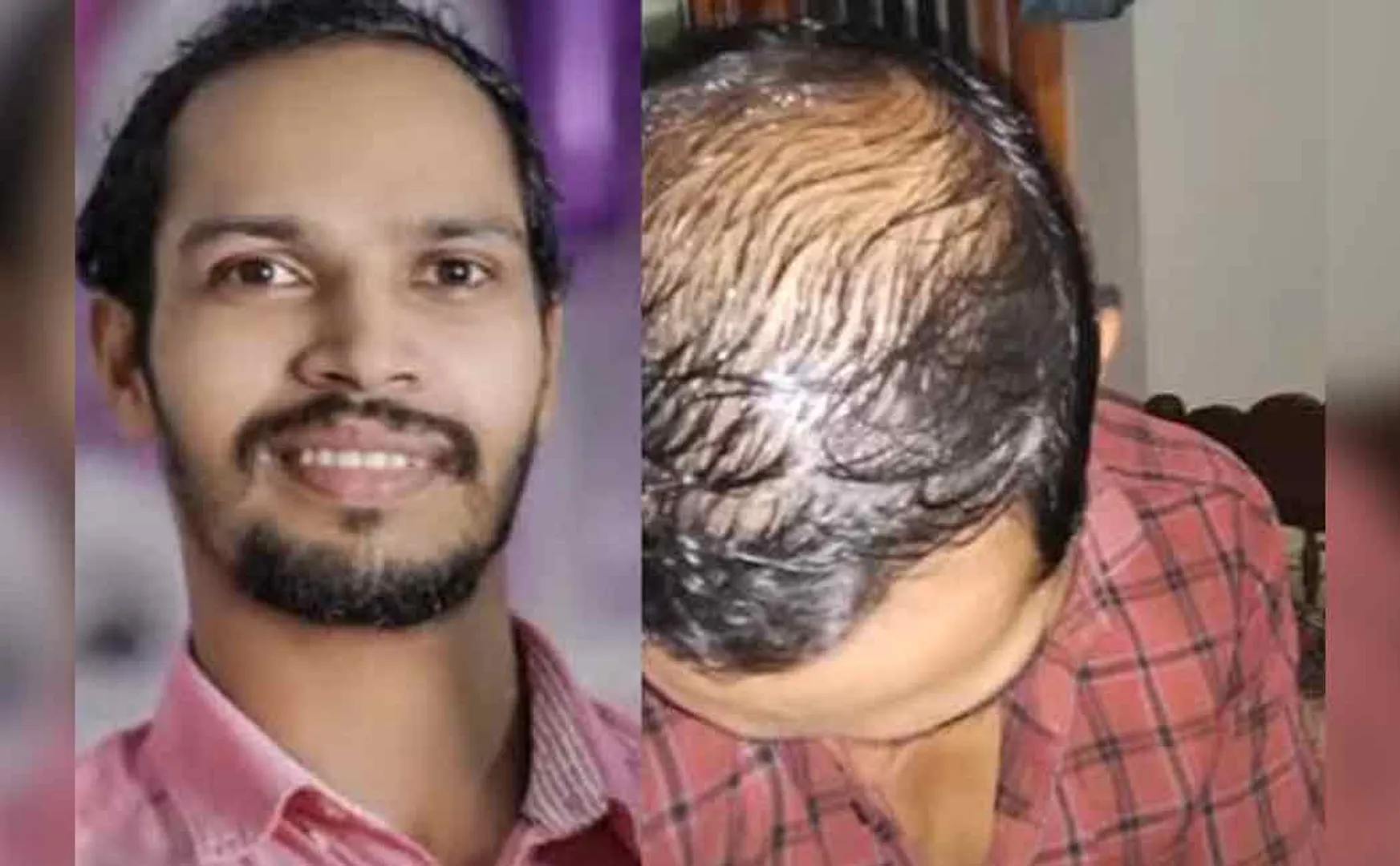 Hair loss problem; A young man who commits suicide